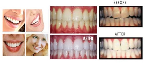 5 XL 38% Teeth Whitening Gel Dentist Recommended High Intensity Carbamide Peroxide Pro Dental Lab Direct, Sensitivity Free, Sold by Dentists, Whiter Smile Labs Fast WHITENING Results