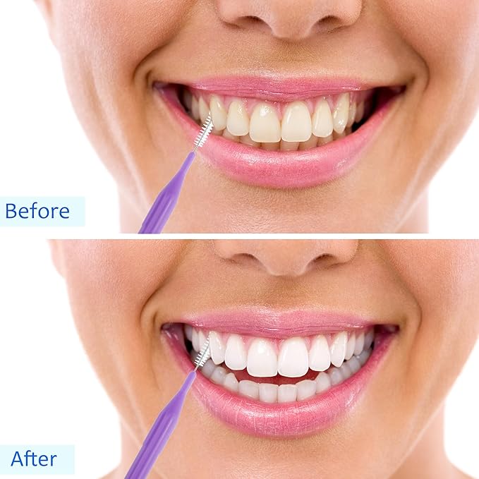 Patelai 100 Pieces Braces Brush for Cleaner Interdental Brush Toothpick Dental Flossing Head Oral Hygiene Flosser Tooth Cleaning Tool(Orange, Purple)
