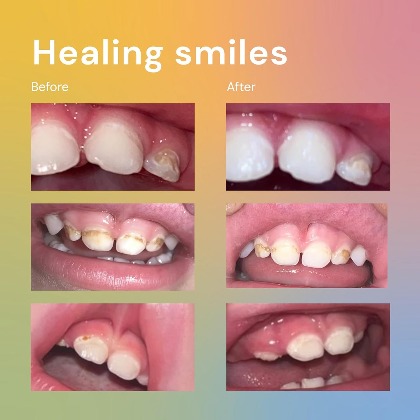 Bliss Energetics Primal Puddy - 1oz Remineralizing Tooth Spot Treatment - Hydroxyapatite, Tallow, Colostrum, Shilajit - All Natural Preservative & Chemical Free