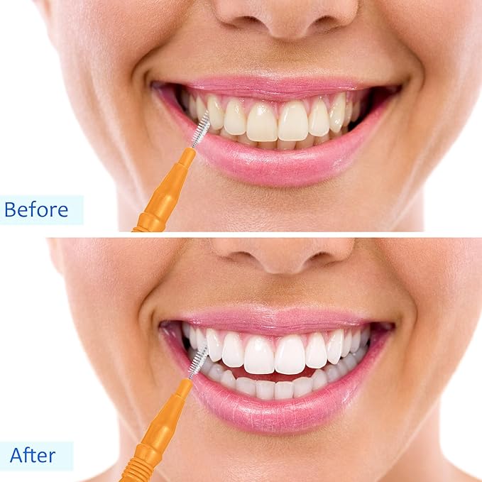 BBTO 100 Pcs Braces Dental Brush Flosser for Cleaner Interdental Brush Toothpick Tooth Flossing Head Oral Dental Toothpick Cleaners Cleaning Tool(Orange)