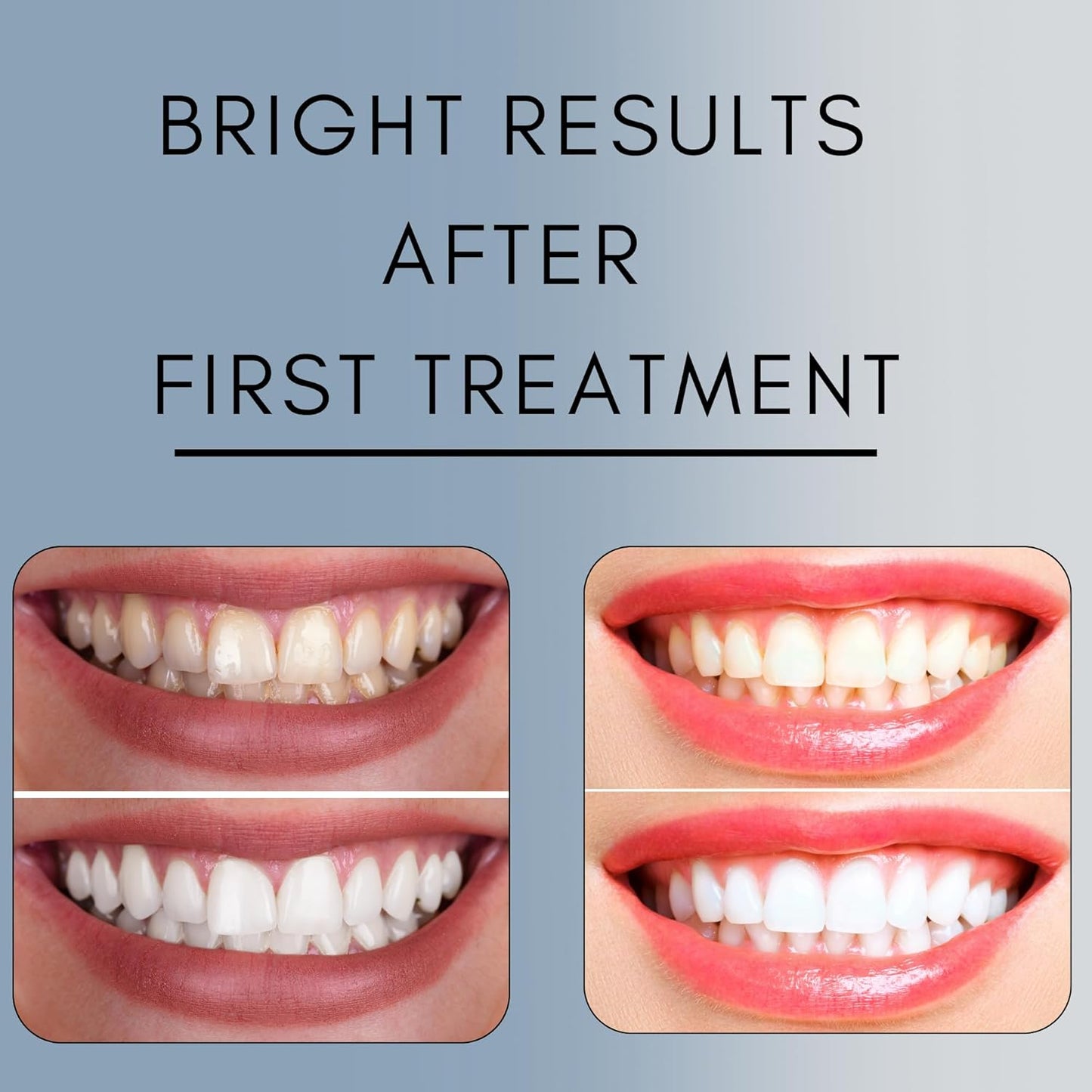 Teeth Whitening Gel for Trays - Professional Strength 44% Carbamide Peroxide, 5 Syringes (50 Treatments) + 2 Trays – Enamel Safe, Removes Coffee & Other Stains