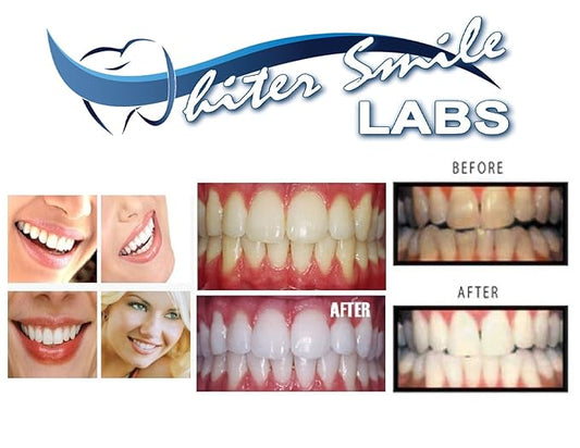 5 XL 38% Teeth Whitening Gel Dentist Recommended High Intensity Carbamide Peroxide Pro Dental Lab Direct, Sensitivity Free, Sold by Dentists, Whiter Smile Labs Fast WHITENING Results