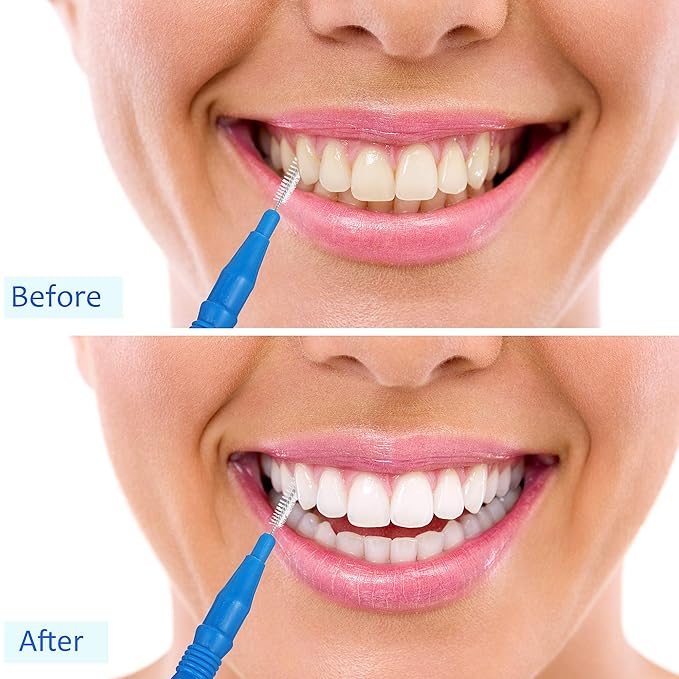 BBTO 100 Pcs Braces Dental Brush Flosser for Cleaner Interdental Brush Toothpick Tooth Flossing Head Oral Dental Toothpick Cleaners Cleaning Tool(Red, Blue, Green, Light Blue)