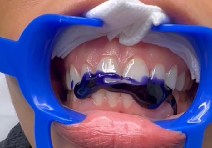 LaserGlow Purple Color Corrector Toothpaste – Health.com #1 Ranked Stain-Neutralizing Formula, Instant Teeth Brightening & Enamel-Safe Whitening, 3.4 oz Tube