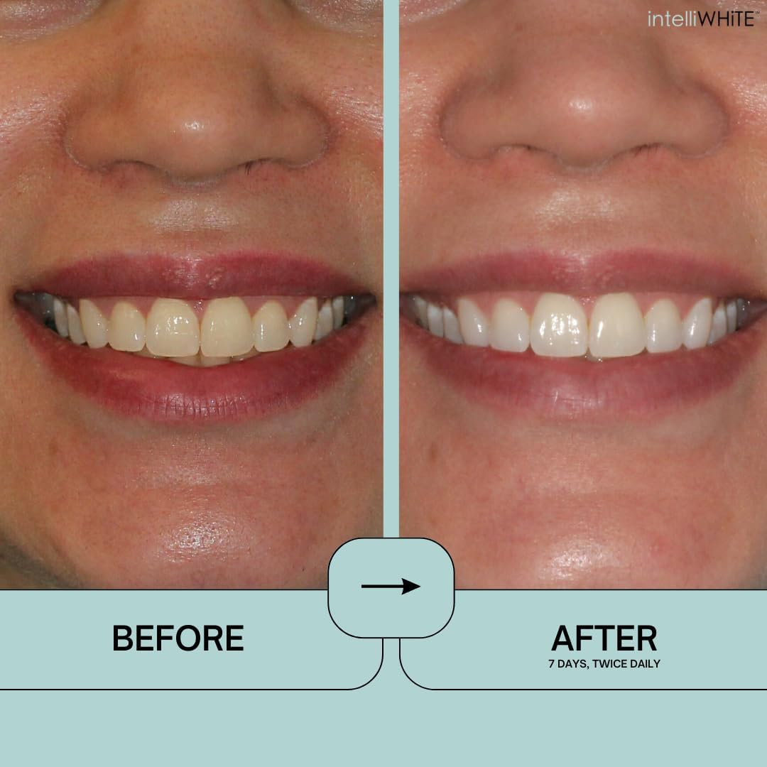 Prostrips - 12 Shades Whiter Teeth - 28 Enamel Safe REMINERALIZING Gentle Strips – 97% no Sensitivity