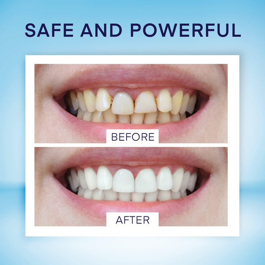 Teeth Whitening Pen (4 Pens) for Teeth Whitening, 40+ Uses, Effective, Painless, No Sensitivity, Travel-Friendly, Beautiful White Smile, Mint Flavor