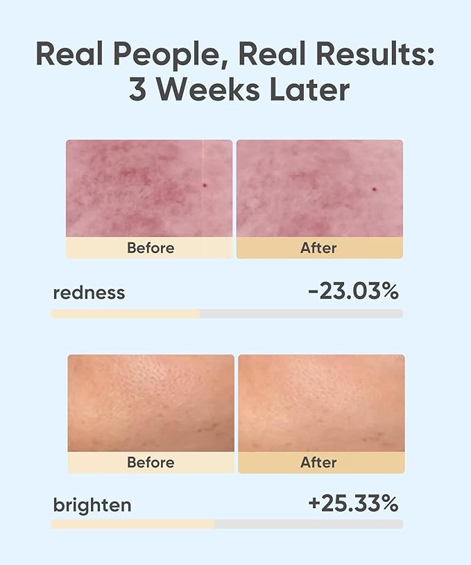 LED Light Therapy Mask, Red Light Therapy for Face - Red Light for Anti-Aging & Wrinkles, Blue for Acne, IR for Deep Repair, At-Home Device, FDA Cleared, Portable & Rechargeable