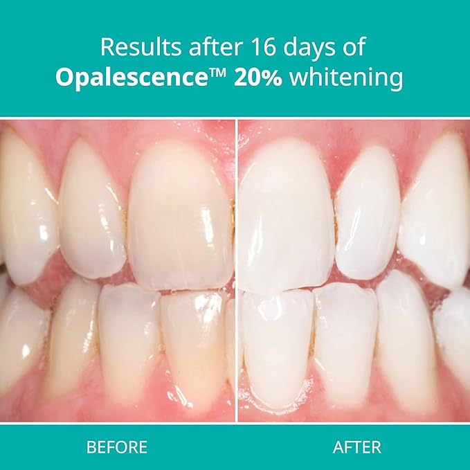 Opalescence 20% with PF Gel Syringes Teeth Whitening (4 Syringes) Refill Kit Carbamide Peroxide. Made by Ultradent, in Melon Flavor. Tooth Whitening Refill Syringes 5401-2