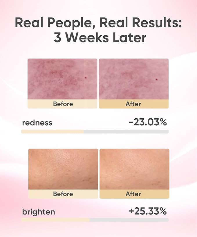 LED Light Therapy Mask, Red Light Therapy for Face - Red Light for Anti-Aging & Wrinkles, Blue for Acne, IR for Deep Repair, At-Home Device, FDA Cleared, Portable & Rechargeable, Pink