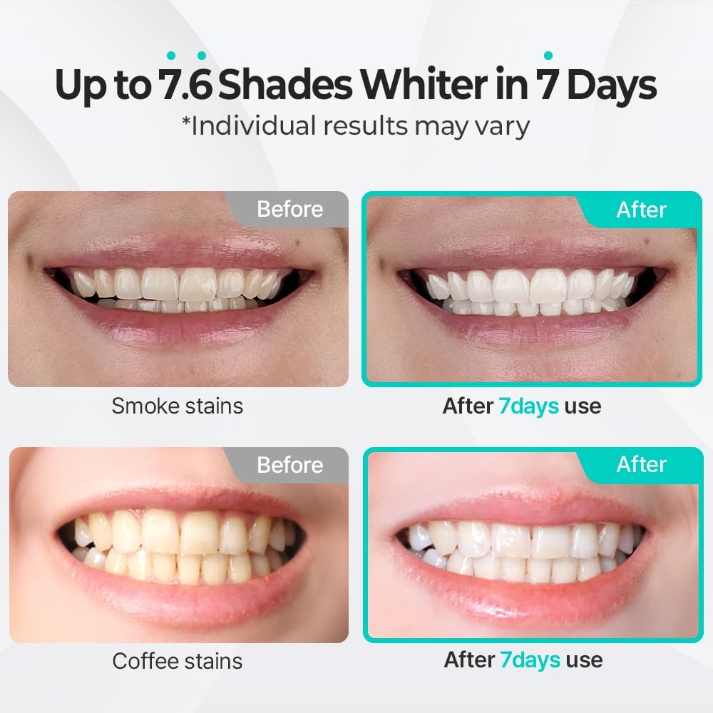 Live Orals PureDia Teeth Whitening Kit - Gel & Mouthpiece Set, Hydrogen Peroxide, Dentist Formulated for Sensitive Teeth, 28 Treatments.