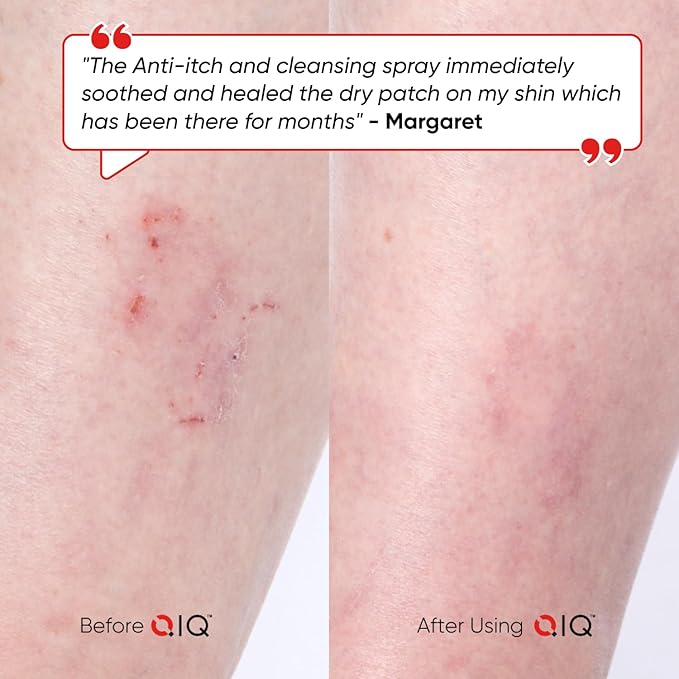 Itch Relief Spray – High Purity Hypochlorous Acid Spray, Fast Anti Itch Relief from Bug Bites, Rashes, Scrapes, Burns, and Helps Provide Relief from Eczema, Steroid & Alcohol-Free (3.4oz)