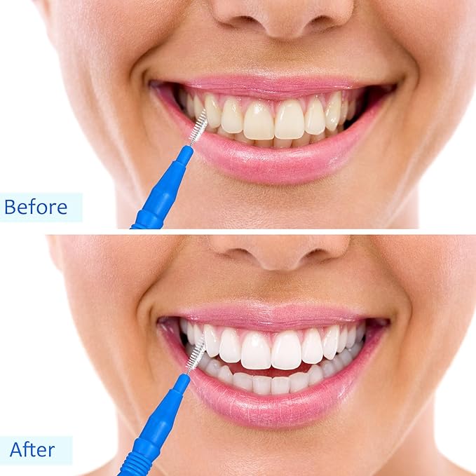 BBTO 100 Pcs Braces Dental Brush Flosser for Cleaner Interdental Brush Toothpick Tooth Flossing Head Oral Dental Toothpick Cleaners Cleaning Tool(Blue)