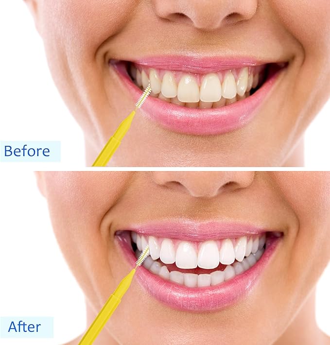 Patelai 100 Pieces Braces Brush for Cleaner Interdental Brush Toothpick Dental Tooth Flossing Head Oral Dental Hygiene Flosser Toothpick Cleaners Tooth Cleaning Tool(Blue, Yellow,Multiple Sizes)