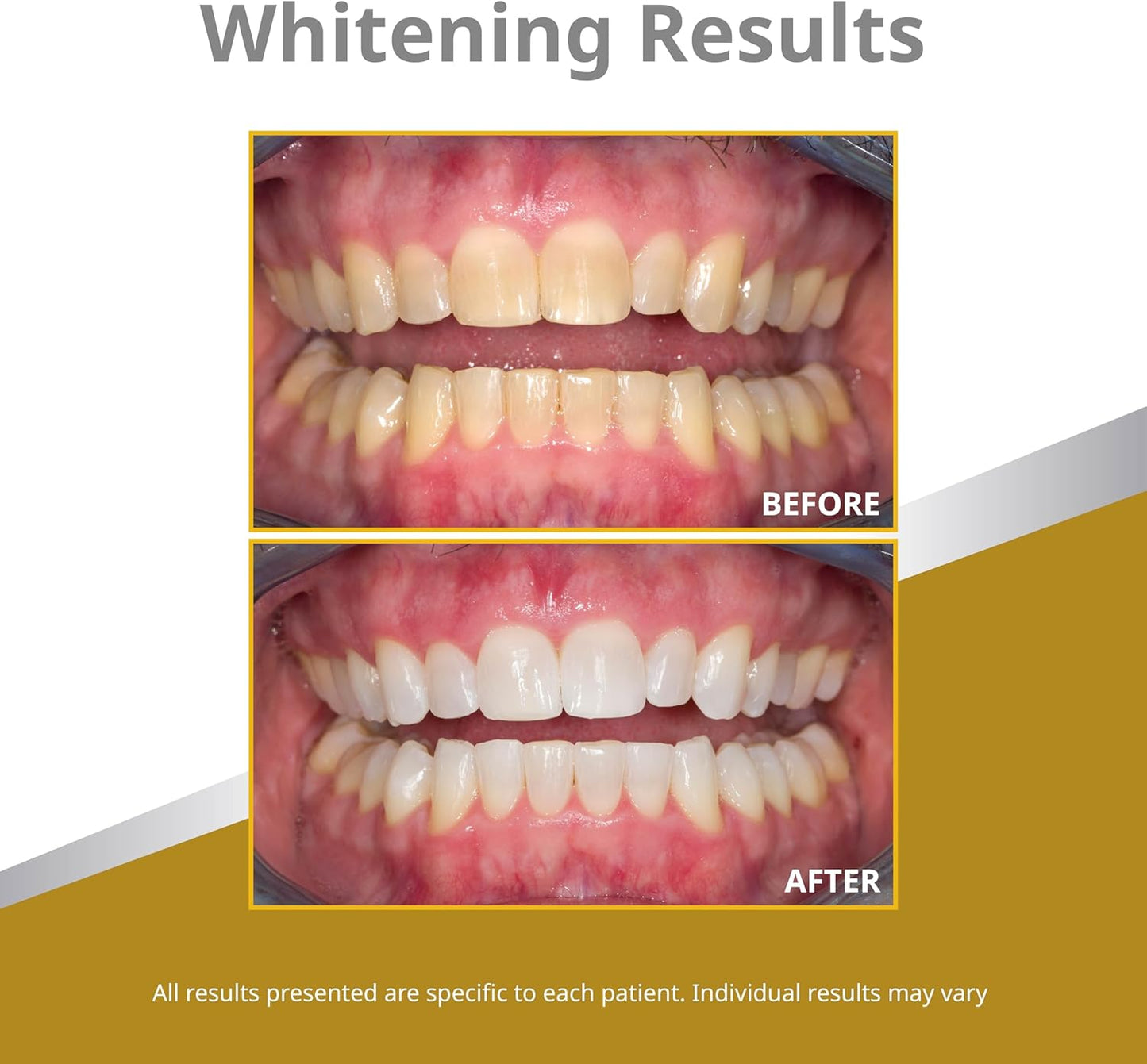 Opalescence 45% Syringes Teeth Whitening Gel - with PF - (12 Syringes) Refill Kit Carbamide Peroxide. Made by Ultradent, in Mint Flavor. Tooth Whitening 5359-6