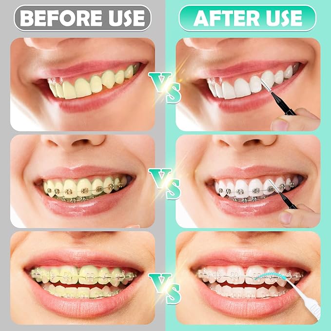 320-Piece Interdental Brush Set, Soft & Flexible Floss Picks for Braces, Orthodontic Care, Teeth Cleaning, 120 Black Spiral Brushes 200 Green Picks, Reusable Oral Care Essentials