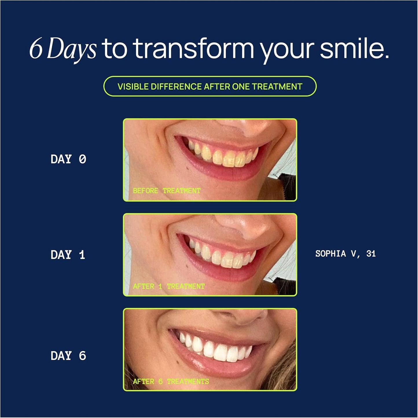 Laughland Super Strength Teeth Whitening Kit, Phone-Powered LED Mouthpiece & 3 Whitening Gel Syringes, 11% Hydrogen Peroxide, Glycerin, Aloe Vera & Mint, at Home Dental Care, 6+ Treatments