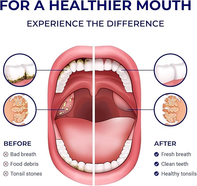 ORAVIX Dental Water Flosser, Tonsil Stone Remover, Gentle Oral Irrigator for Sensitive Teeth and Gums, Kids Manual Water Flosser, No Electricity or Batteries