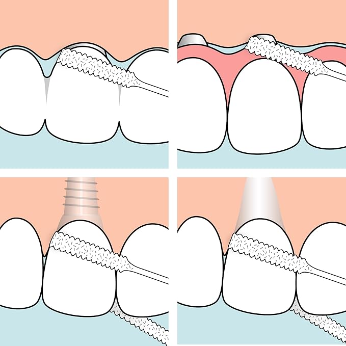 TePe Bridge and Implant Floss for Dental Implants, Bridges, and Braces, Dental Flossers, 30 Pieces