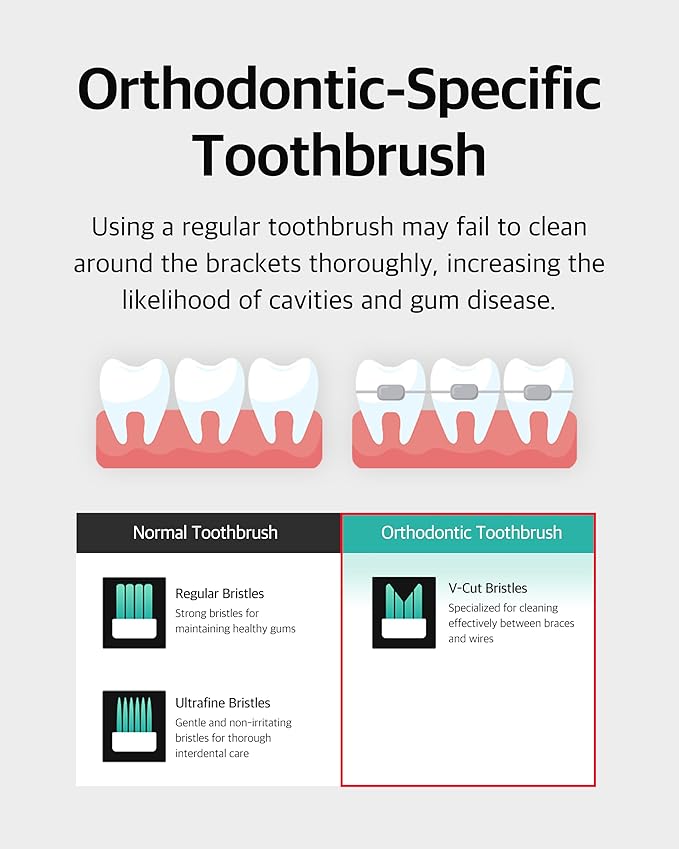 V-Cut Orthodontic Toothbrush(White) - Compact Head for Braces, Ergonomic Handle, Deep Cleaning, Gentle Bristles for Brackets and Wires
