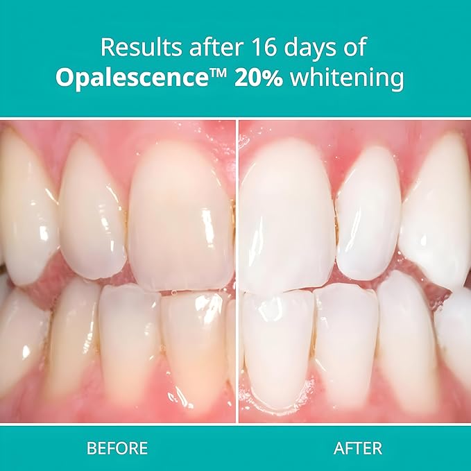 Opalescence 20% with PF Gel Syringes Teeth Whitening - Refill Kit (12 Syringes) Carbamide Peroxide. Made by Ultradent, in Melon Flavor. Tooth Whitening 5401-6