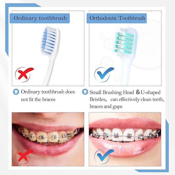 6 Pieces V Shaped Orthodontic Toothbrush for Brace with Brush Head 40 Pieces Interdental Brush Soft Bristle Braces Brushes for Cleaning Portable Toothbrushes for Braces(Medium,Orange)