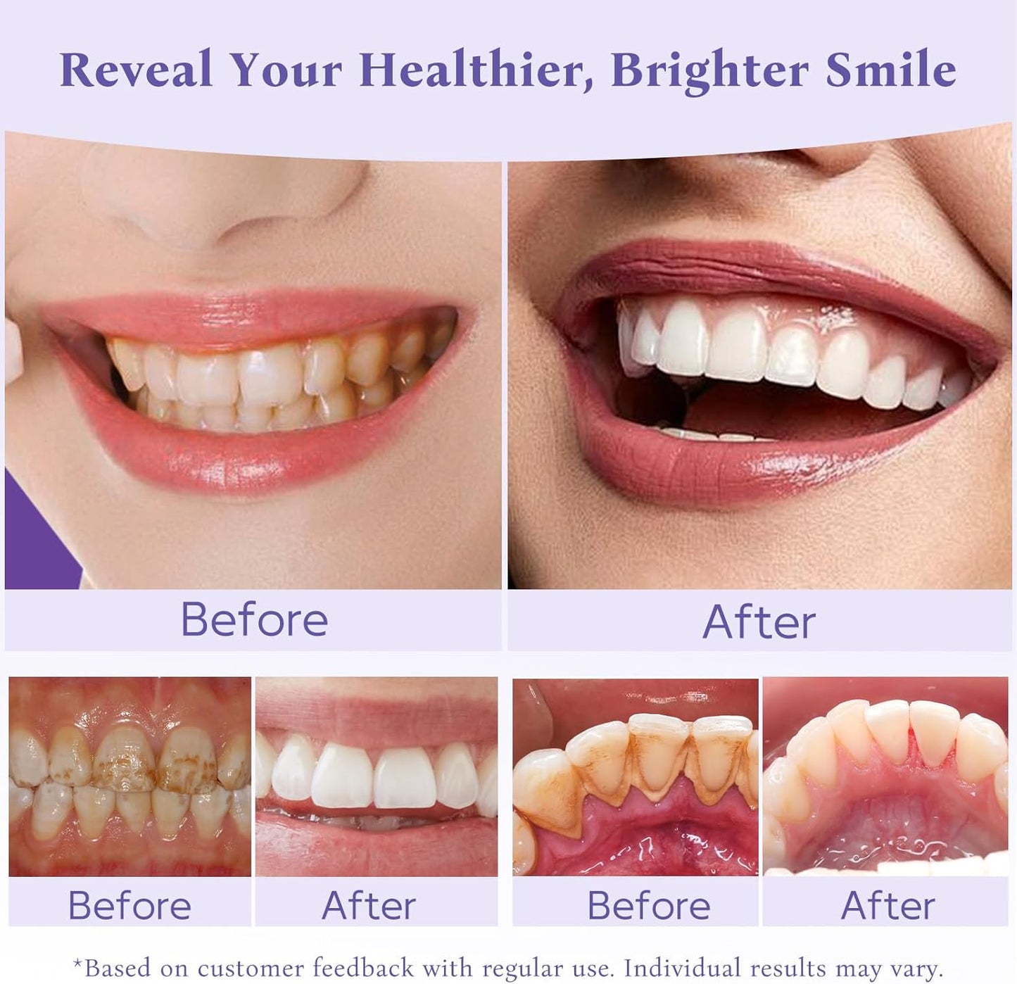 Teeth Whitening Powder,Remineralizing Hydroxyapatite Tooth Powder with Niacinamide,R5X Purple Color Corrector for Instant Brightening, Enamel Repair & Long-Lasting Natural White-30g