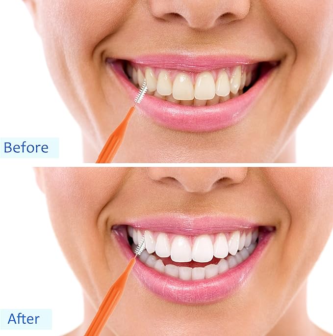 Patelai 100 Pieces Braces Brush for Cleaner Interdental Brush Toothpick Dental Flossing Head Oral Hygiene Flosser Tooth Cleaning Tool(Light Blue,Pink,Yellow,Orange)