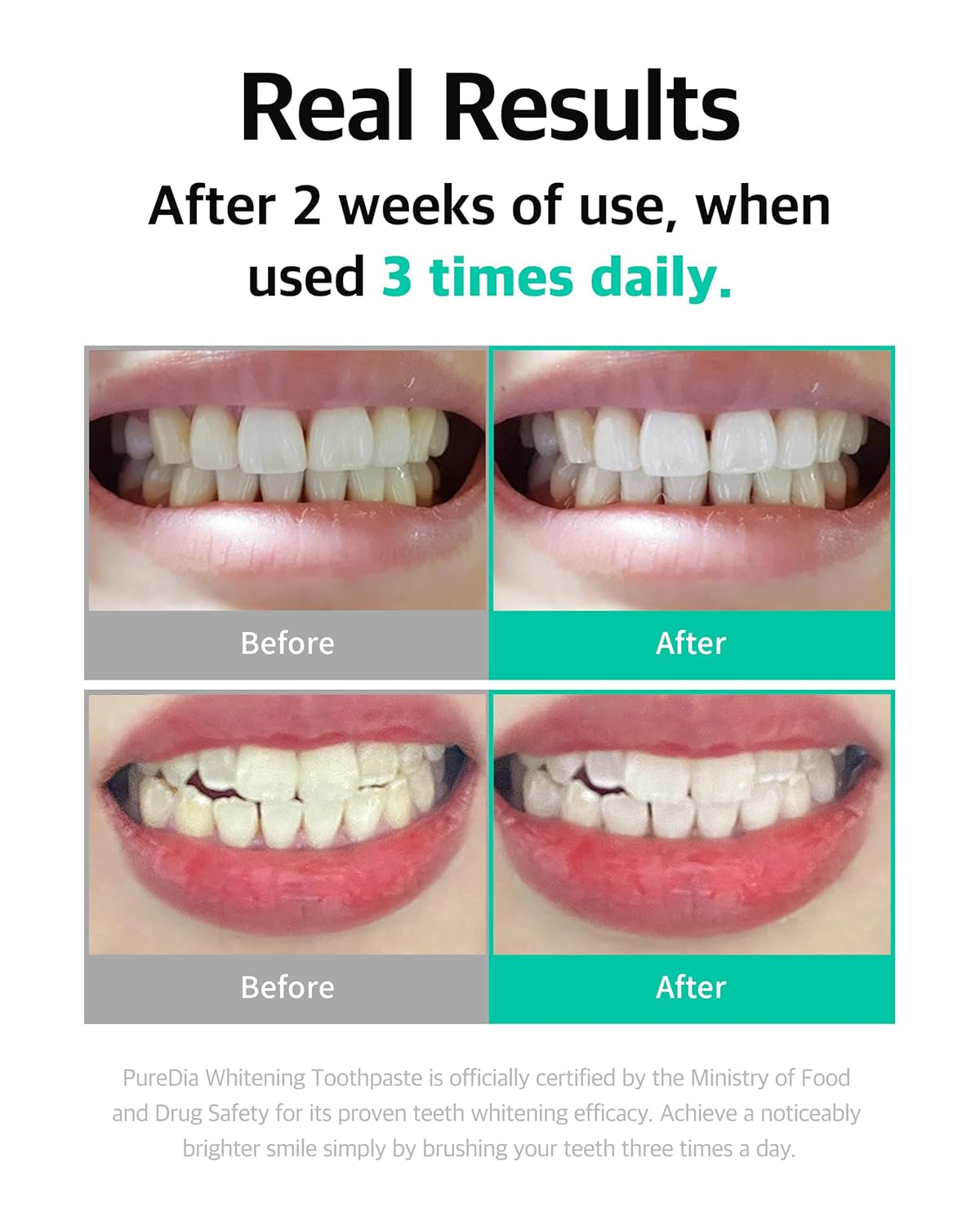 Live Orals Whitening Toothpaste 80g x 5 Units - Fluoride-Free, Nano Hydroxyapatite & Hydrogen Peroxide, Sensitive Teeth, Enamel Strengthening, Natural Mint Gel