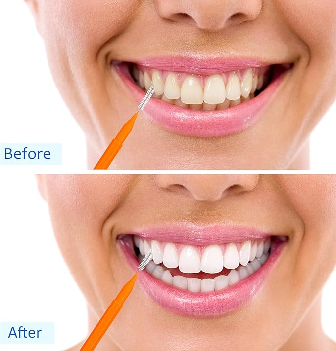 Patelai 100 Pieces Braces Brush for Cleaner Interdental Brush Toothpick Dental Tooth Flossing Head Oral Dental Hygiene Flosser Toothpick Cleaners Tooth Cleaning Tool(White, Orange, Blue,Proper Size)