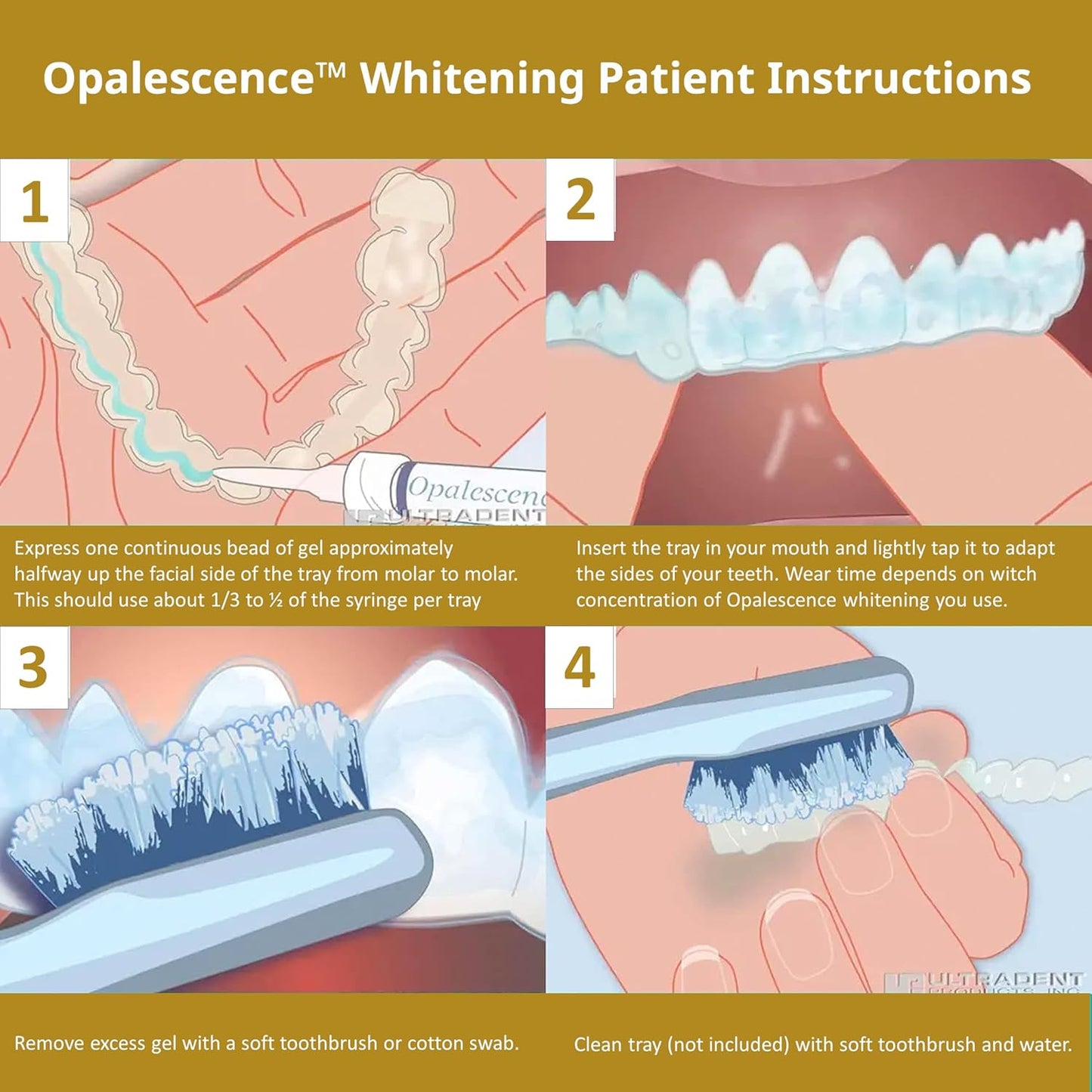 Opalescence 45% Syringes Teeth Whitening Gel - with PF - (12 Syringes) Refill Kit Carbamide Peroxide. Made by Ultradent, in Mint Flavor. Tooth Whitening 5359-6