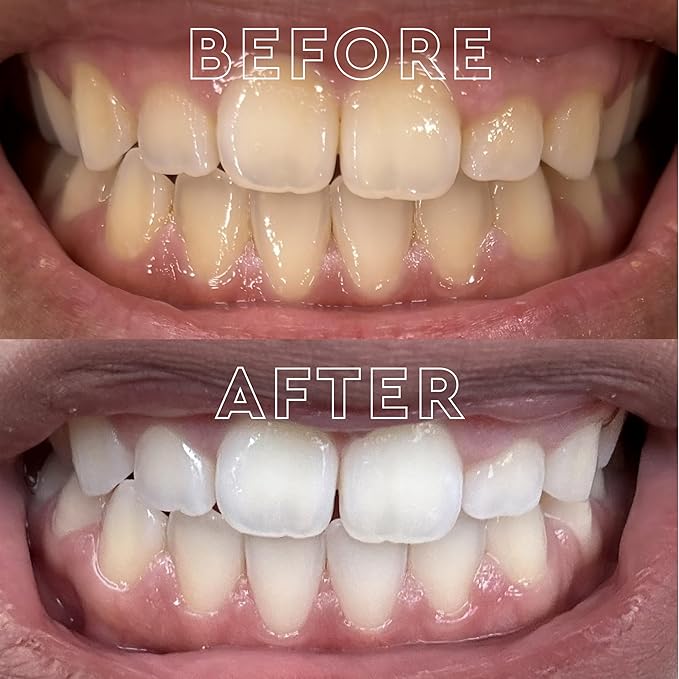 MOON Dissolving Teeth Whitening Strips, 28 Platinum Express No Rinse White Strips, Winter Mint, Hydrogen Peroxide & Essential Oils, Whiten Sensitive Teeth up to 8 Shades in 1 Week, Travel Essentials