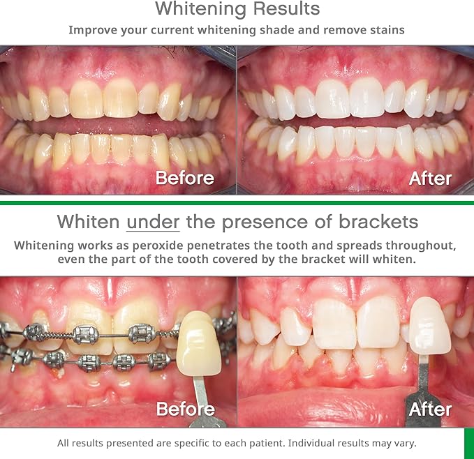 Opalescence Teeth Whitening Bundle - Opalescence Go 15% Hydrogen Peroxide Prefilled Trays (10 Trearments) and Sensitive Whitening Toothpaste 4.7 Onz - Mint Flavor 5194-5167