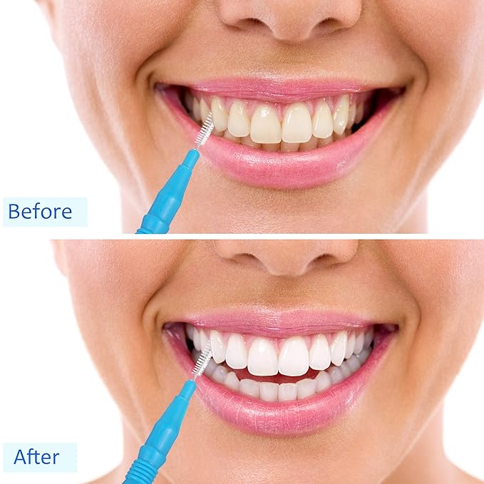 BBTO 100 Pcs Braces Dental Brush Flosser for Cleaner Interdental Brush Toothpick Tooth Flossing Head Oral Dental Toothpick Cleaners Cleaning Tool(Red White Green Light Green, Light Blue)