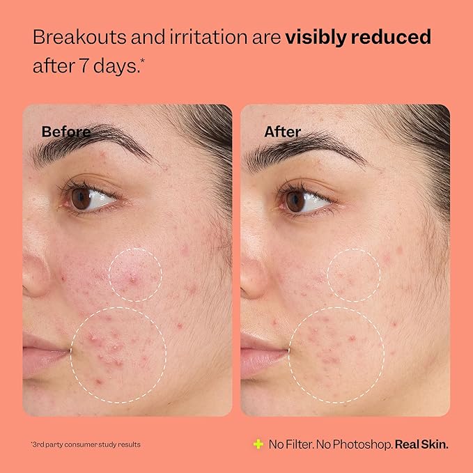 Peach Slices - Fix All Recovery Spray (4 oz) - Purify, Soothe, & Relieve - Zits, Stressors, & Redness - Hypochlorous Acid Spray - Electrolyzed Water - Vegan & Cruelty Free - Korean Skin Care & Beauty